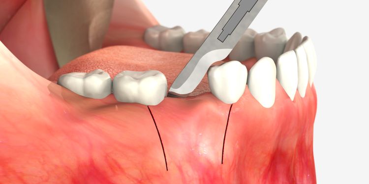 جراحی لثه برای ایمپلنت دندان