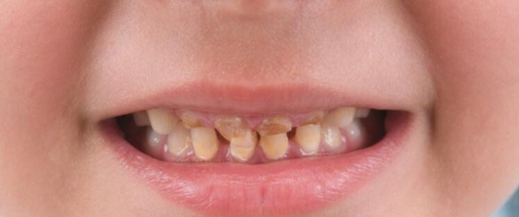 اثرات ناشی از مراقبت نامناسب دندانی