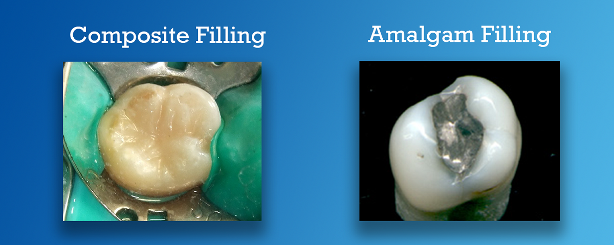 برای پر کردن دندان آمالگام بهتر است یا کامپوزیت؟
