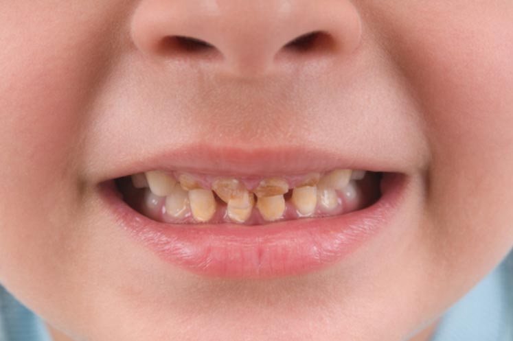 دلایل آسیب دیدن دندان شیری کودکان