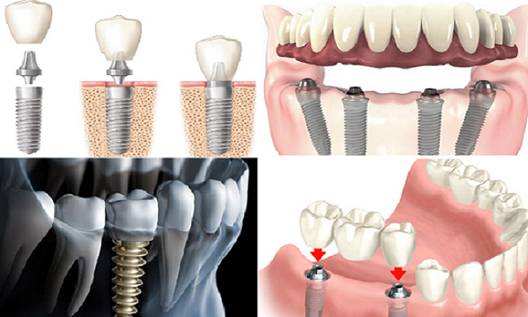 برندهای ایمپلنت دندان