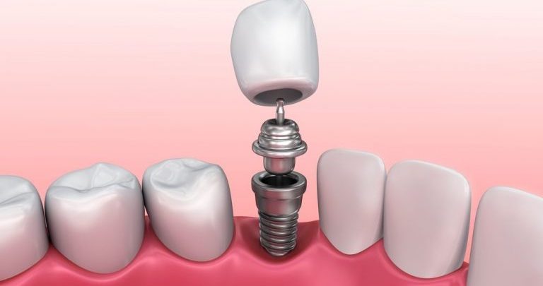 خارج کردن ایمپلنت دندان کشیدن ایمپلنت دندان