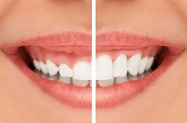 افزایش-طول-تاج دندان