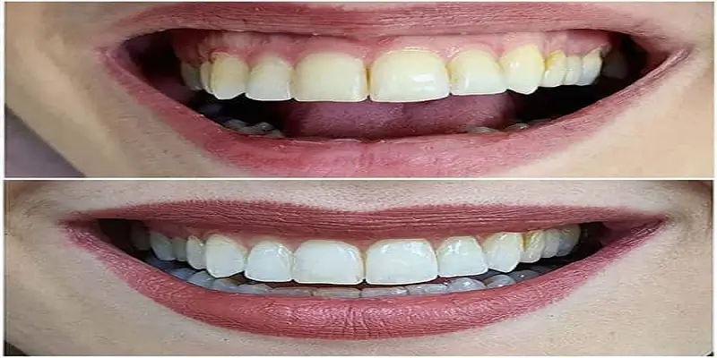 ماندگاری سفیدی دندان بعد از بلیچینگ