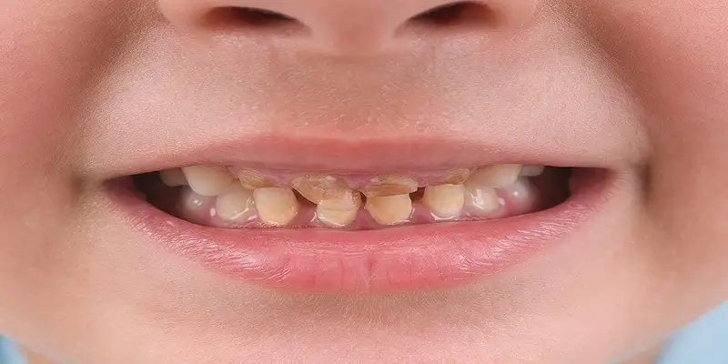 علت تغییر رنگ دندان