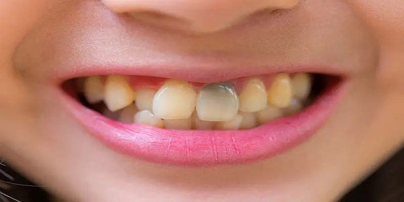علت تغییر رنگ دندان