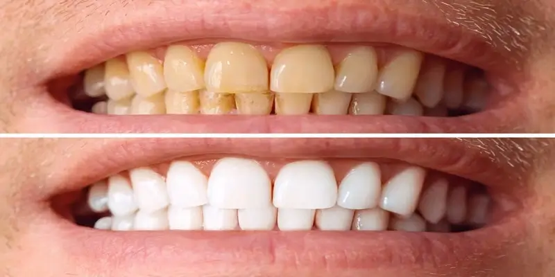 ماندگاری سفیدی دندان بعد از بلیچینگ